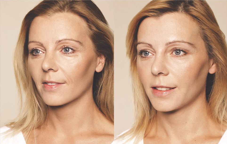 BEFORE &amp; AFTER Skin Booster Treatments